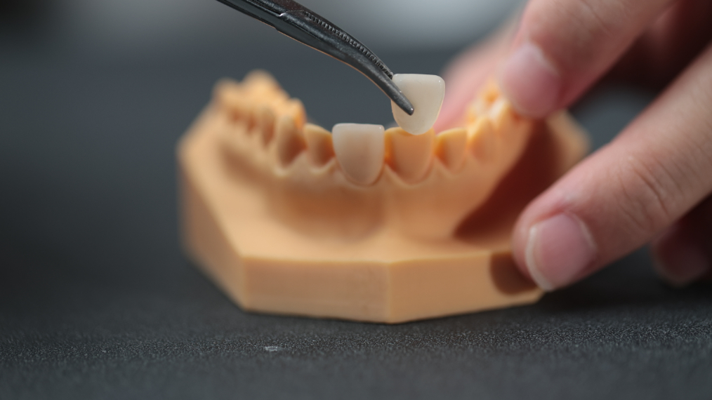 Veneer