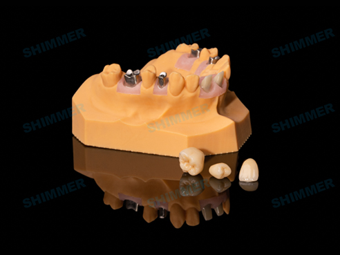 Implant Custom Abutment Case