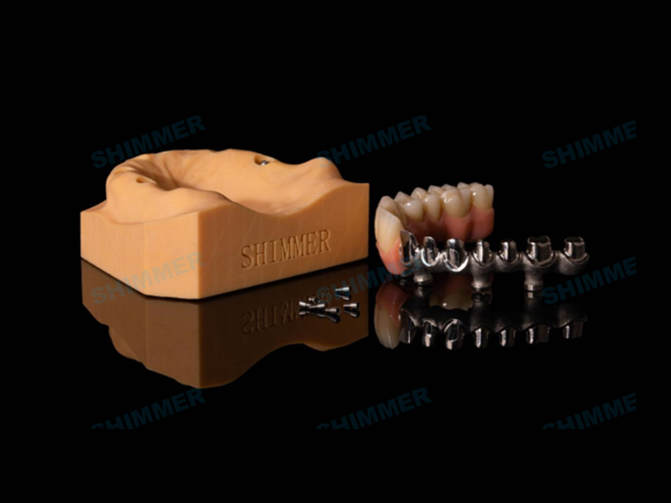 E.max Press Veneer